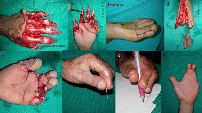 Hands and Fingers Injuries